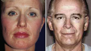 Whitey Bulger Search Moves To Plastic Surgery Newsletter