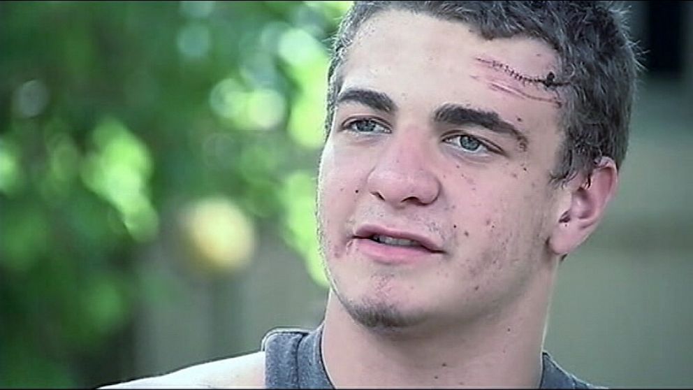 PHOTO: 17-year old Andrew Hudson, was attacked by a gator after he thought he kicked a log in a swimming hole. The gator clenched his head between his jaws and pulled him under.
