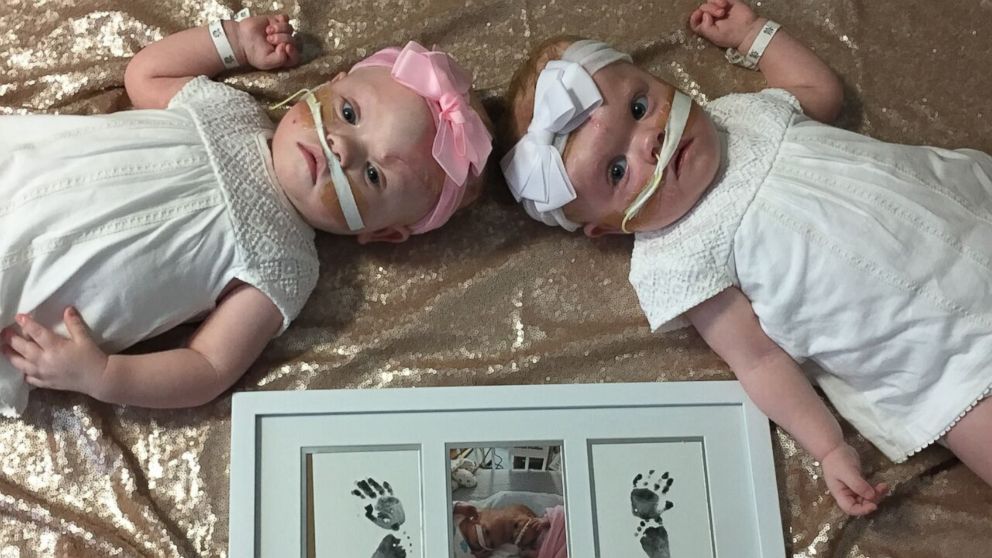 Conjoined Twins Videos At Abc News Video Archive At 1836