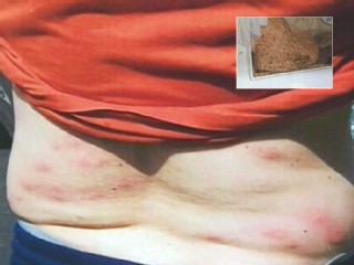Man Stung By More Than 100 Yellow Jackets