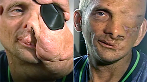 PHOTO neurofibromatosis