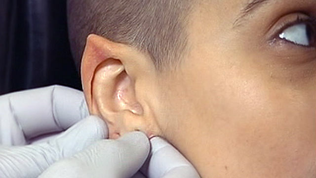 Ear Pointing Surgery Elf Ears Or Mr Spock Abc News