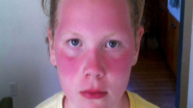 PHOTO: Severely sunburned at school, Violet and Zoe Michener came home from field day so burned that their mother rushed them to the hospital.