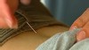 Video: Women abandoned at acupuncture clinic with needles in her back.