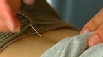 Video: Women abandoned at acupuncture clinic with needles in her back.