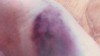 VIDEO: Mary Massa says her bruise from a blood draw looks like Jesus. 
