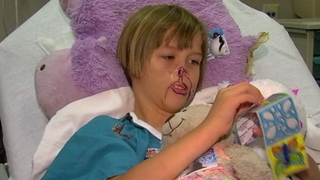VIDEO: Family pet tore off 10-year-old Michigan girls ear, upper lip and nose when she was an infant.
