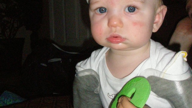 PHOTO: Nine-month-old Jameson Davis, seen in this undated handout photo, is a bilateral amputee and at seven-months-old became the youngest to be fitted with bilateral passive prosthesis through Advanced Arm Dynamics Prosthetic.