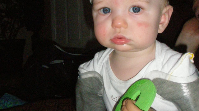 PHOTO: Nine-month-old Jameson Davis, seen in this undated handout photo, is a bilateral amputee and at seven-months-old became the youngest to be fitted with bilateral passive prosthesis through Advanced Arm Dynamics Prosthetic.