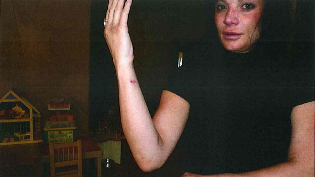 PHOTO:&nbsp;Dina Shacknai's injuries after she said Jonah Shacknai's German shepherd attacked her during a domestic dispute.