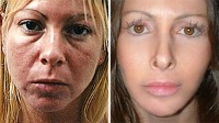 PHOTO Laura Pillarella underwent 15 plastic surgeries.  Now, she says she regrets having them done.