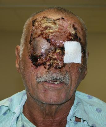 Miami Cannibal Attack
