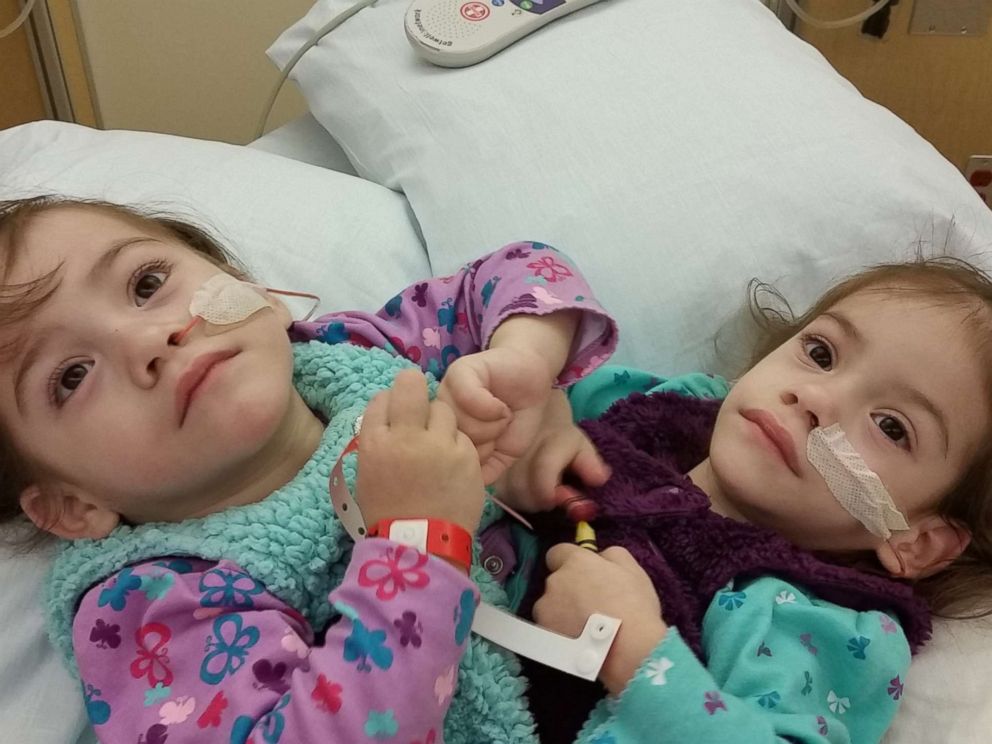 Formerly conjoined twins Eva and Erika Sandoval are seen here before their separation surgery.
