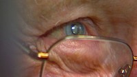 Bionic Sight: FDA OKs Telescope Eye Implant