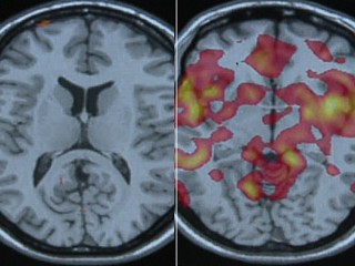 MRI