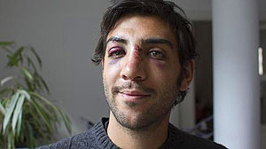 PHOTO: Sherief Gaberf shows his injuries after being struck in the face by pro-Mubarak forces in Cairos Tahrir Square.