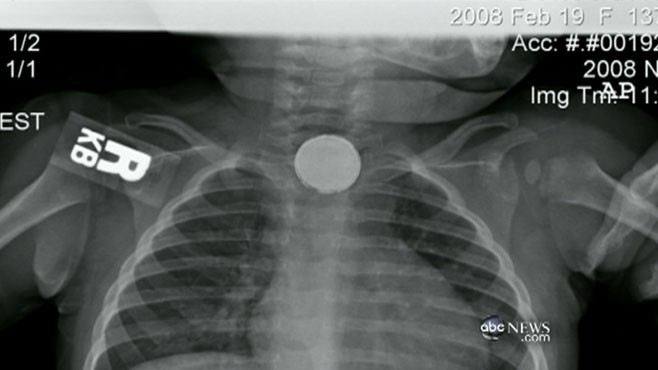 VIDEO: Lithium button batteries can be deadly when swallowed.