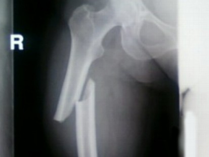VIDEO: Commonly prescribed drug meant to strengthen bones may have the opposite effect.