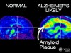 Milestone Test for Alzheimer's