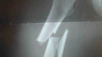 VIDEO: Officials clear up how long patients should be on bone medications.