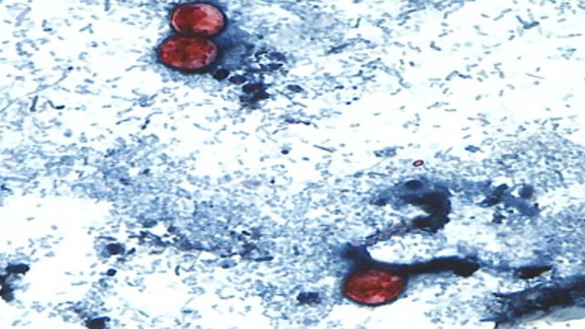 VIDEO: Dr. Richard Besser discusses what is causing 372 cases of the cyclospora stomach bug.