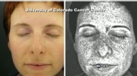 VIDEO: Rising rate of young female patients diagnosed with melanoma.