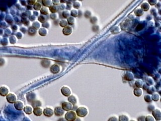 Watch: Meningitis Outbreak: The Scramble