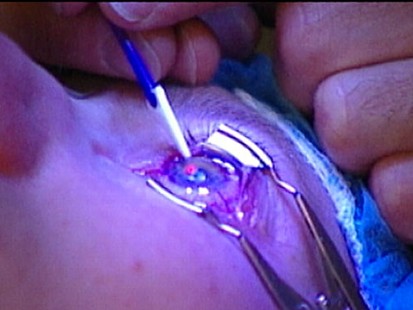 VIDEO: A former official who helped promote the procedure now has new warnings.