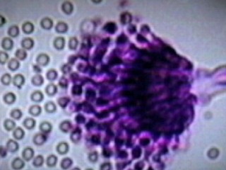Watch: Meningitis Outbreak Linked to Spinal Steroid Injections