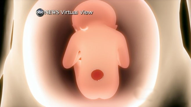 VIDEO: Surgery in the Womb May Help With Spina Bifida