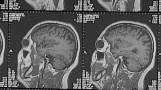 VIDEO: New research shows 11 million Americans have strokes they don't even notice. 