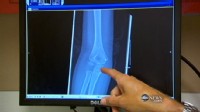 VIDEO: FDA calls for change to children's exposure to radiation from scans.