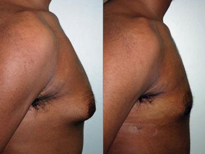 man breast reduction comparison photo