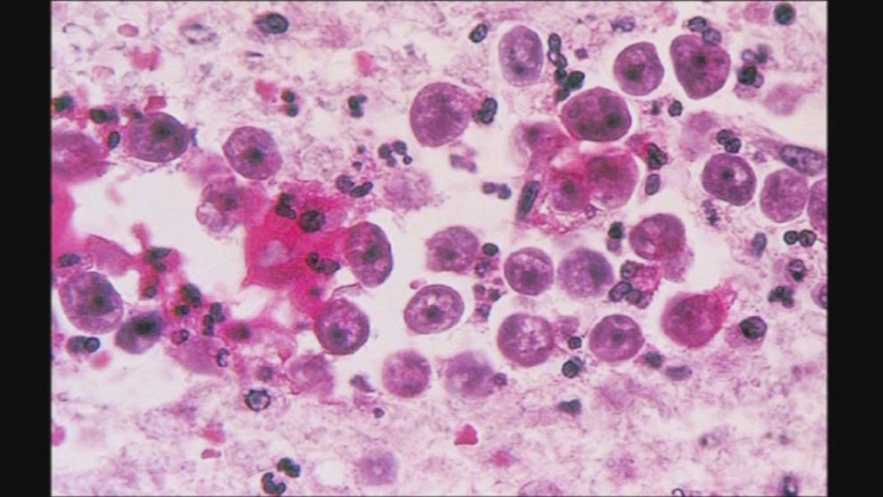 what diseases are caused by amoeba what diseases are caused by amoeba