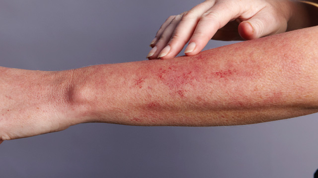 pictures of lyme disease rashes #11