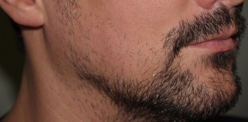 Beards and Other Hair-Raising Transplants on the Rise