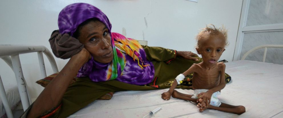 Photos of Malnourished Children Show Horrors of Yemen's Forgotten War ...