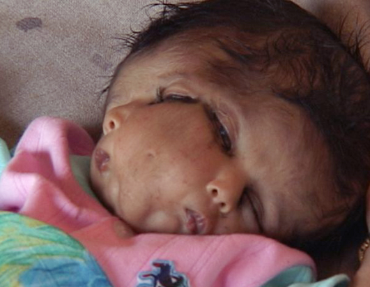 Baby with Two Heads Born in Philippines