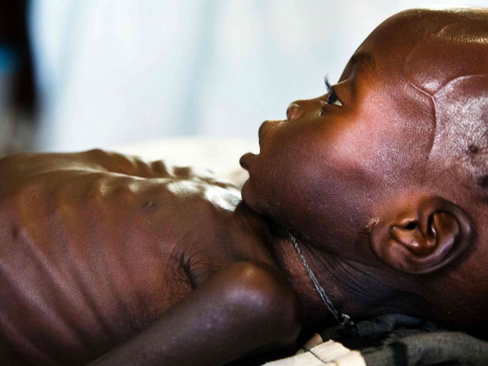 PHOTO: Agop Manut, 11-months-old, who suffers from acute malnutrition and respiratory distress, is assisted at the clinic run by Doctors without Borders (MSF) in Aweil, Northern Bahr al Ghazal, South Sudan, Oct. 11, 2016.