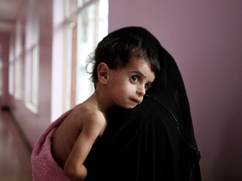 PHOTO: A woman holds her malnourished boy after he was weighed at a hospital malnutrition intensive care unit in Sanaa, Yemen, Sept. 27, 2016.