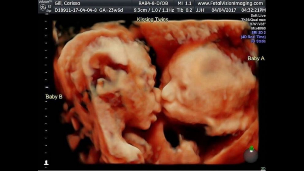Sonogram shows twin sisters 'kissing' inside mother's womb Video - ABC News