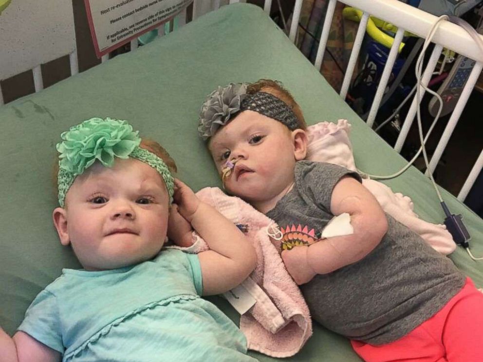 PHOTO: Fifteen-month-olds Erin and Abby Delaney, who were born conjoined by the head. 